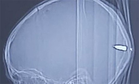 Родители не заметили пулю в голове ребенка и отвели его к врачу