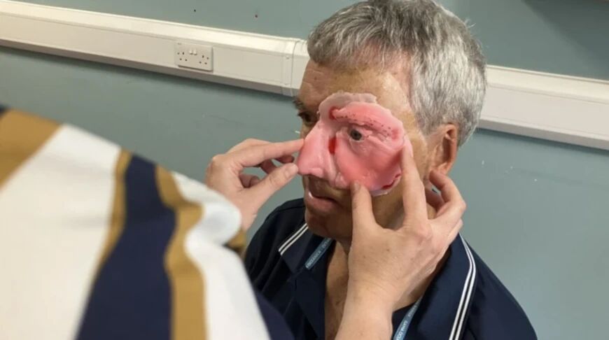 Британцу распечатали лицо на 3D-принтере после серьезной травмы в аварии